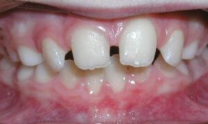 Spacing Icon Orthodontics Surprise Glendale AZ