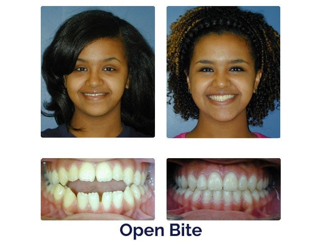 Before and after Porter Orthodontics in Baton Rouge, LA