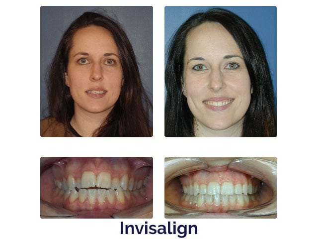 Before and after Porter Orthodontics in Baton Rouge, LA