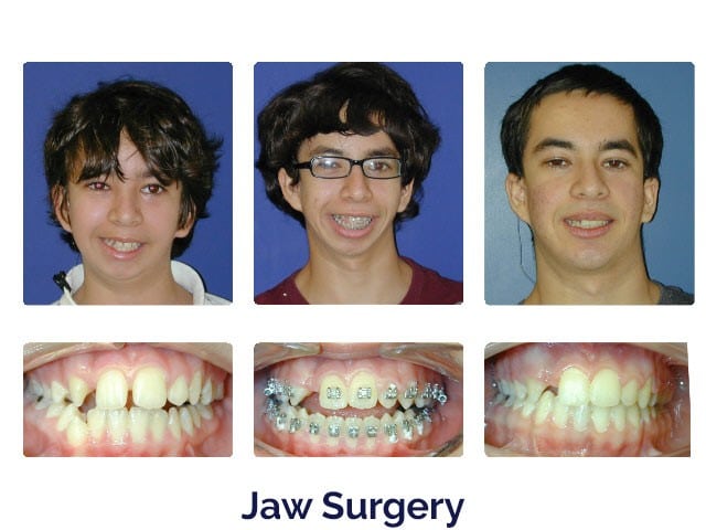 Before and after Porter Orthodontics in Baton Rouge, LA