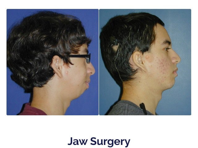 Before and after jaw surgery at Porter Orthodontics in Baton Rouge, LA