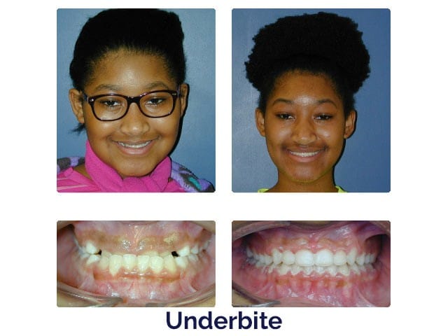 Before and after Porter Orthodontics in Baton Rouge, LA