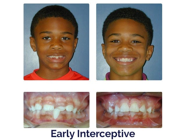 Before and after Porter Orthodontics in Baton Rouge, LA