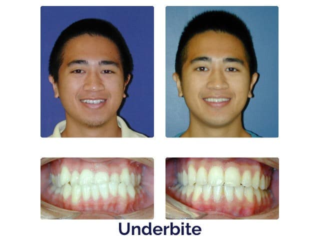 Before and after at Porter Orthodontics in Baton Rouge, LA