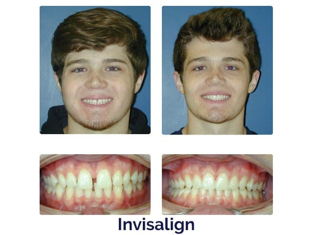 Before and After pictures at Porter Orthodontics in Baton Rouge, LA