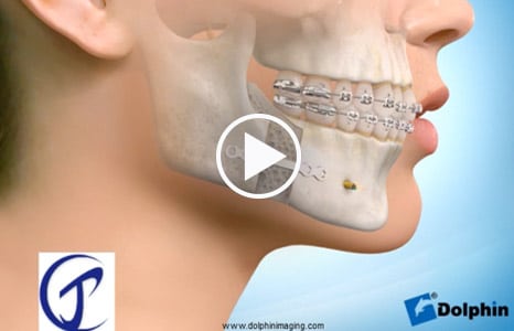 Skeletal problems Porter Orthodontics in Baton Rouge, LA