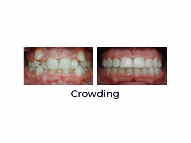 Crowding Porter Orthodontics in Baton Rouge, LA