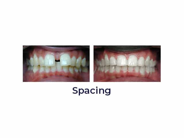 Spacing Porter Orthodontics in Baton Rouge, LA