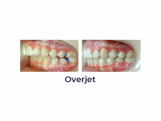 Overjet Porter Orthodontics in Baton Rouge, LA