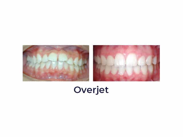 Overjet Porter Orthodontics in Baton Rouge, LA