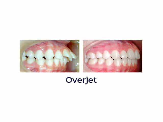 Before and after Porter Orthodontics in Baton Rouge, LA