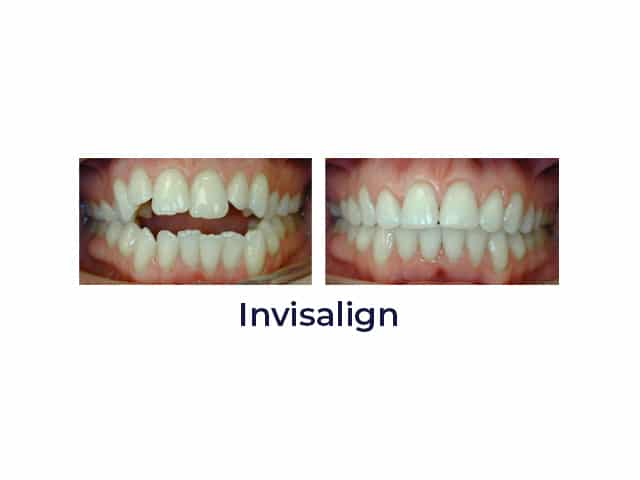 Invisalign before and after Porter Orthodontics in Baton Rouge, LA