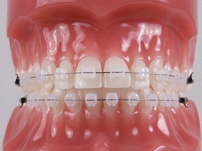 Clear Ceramic Braces Boca Raton  Ceramic Dental Braces West Boca