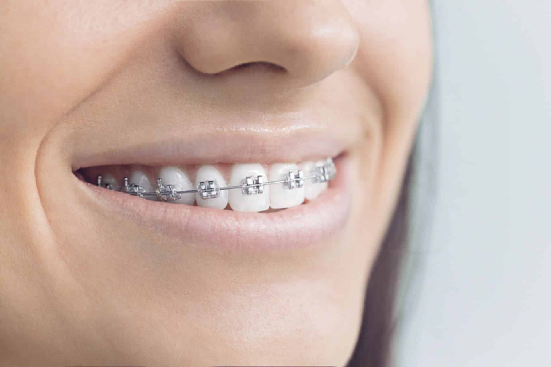 How Much Do Braces Cost in Baton Rouge in 2026? Porter Orthodontics in Baton Rouge, LA