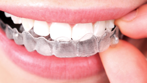 Invisalign